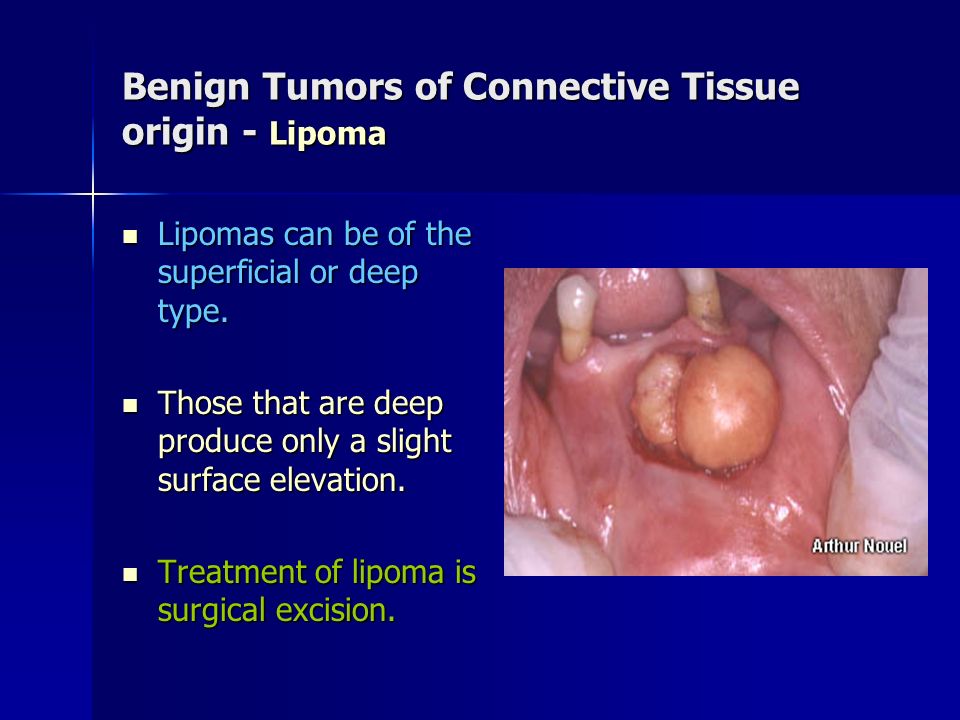 Benign Tumors of Connective Tissue origin - Lipoma