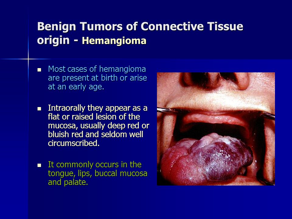 Benign Tumors of Connective Tissue origin - Hemangioma