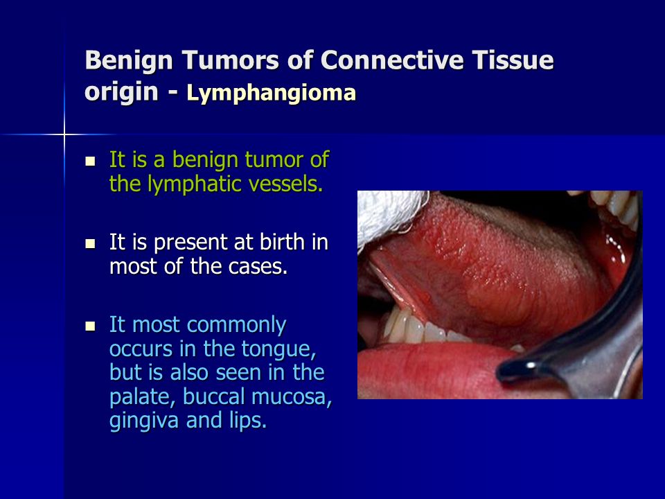 Benign Tumors of Connective Tissue origin - Lymphangioma