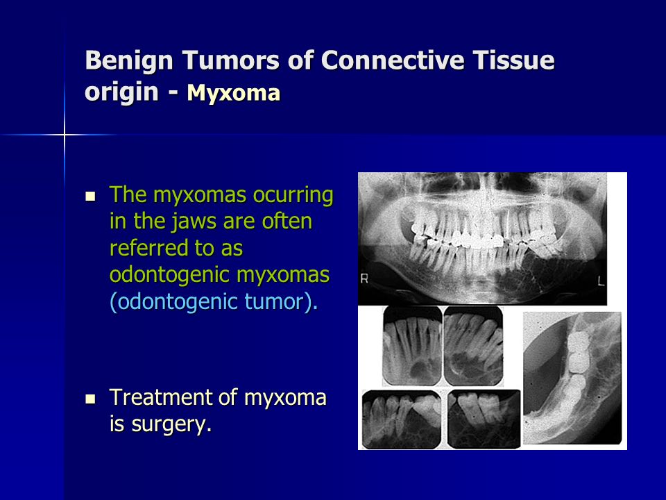 Benign Tumors of Connective Tissue origin - Myxoma