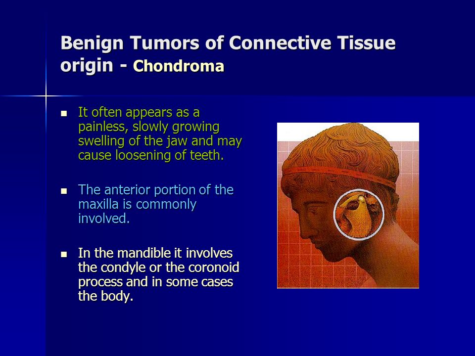 Benign Tumors of Connective Tissue origin - Chondroma