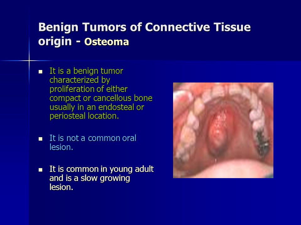 Benign Tumors of Connective Tissue origin - Osteoma
