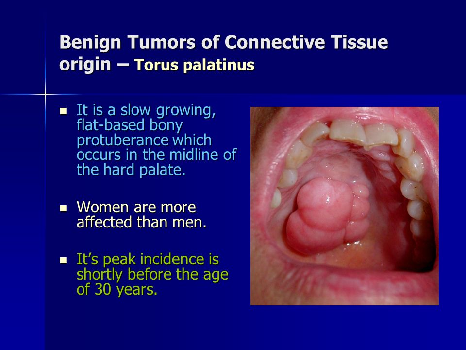 Benign Tumors of Connective Tissue origin – Torus palatinus