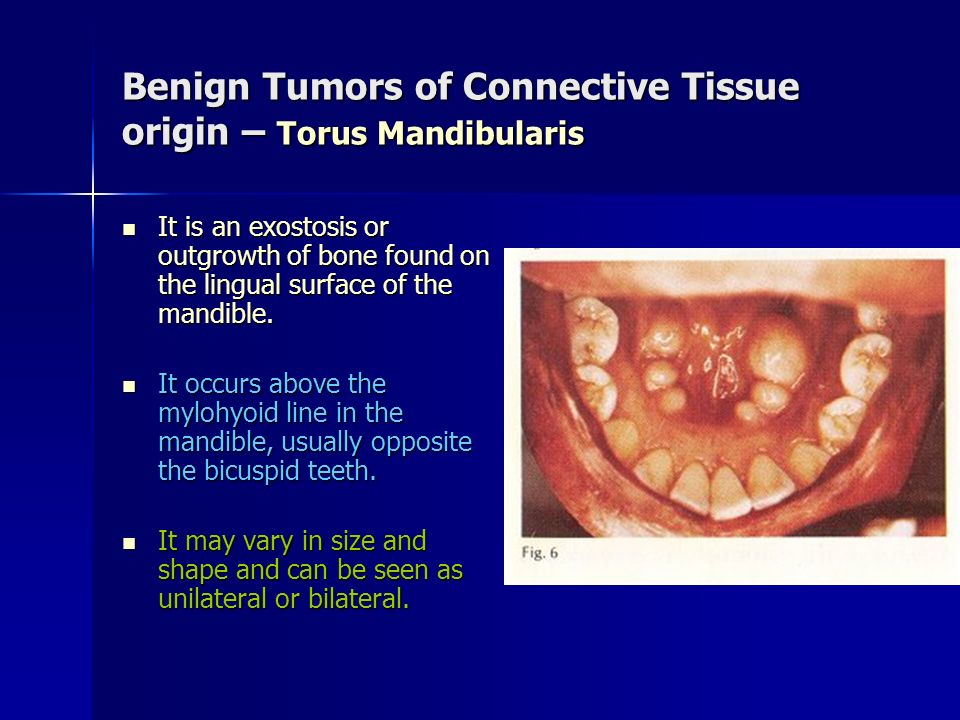 Benign Tumors of Connective Tissue origin – Torus Mandibularis