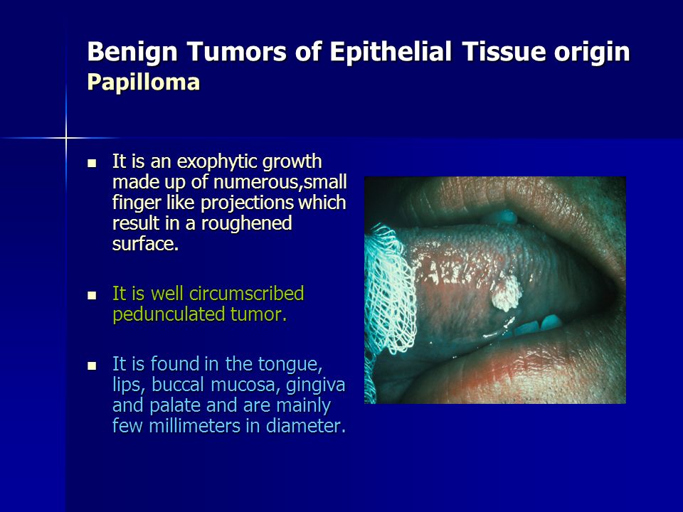 Benign Tumors of Epithelial Tissue origin Papilloma