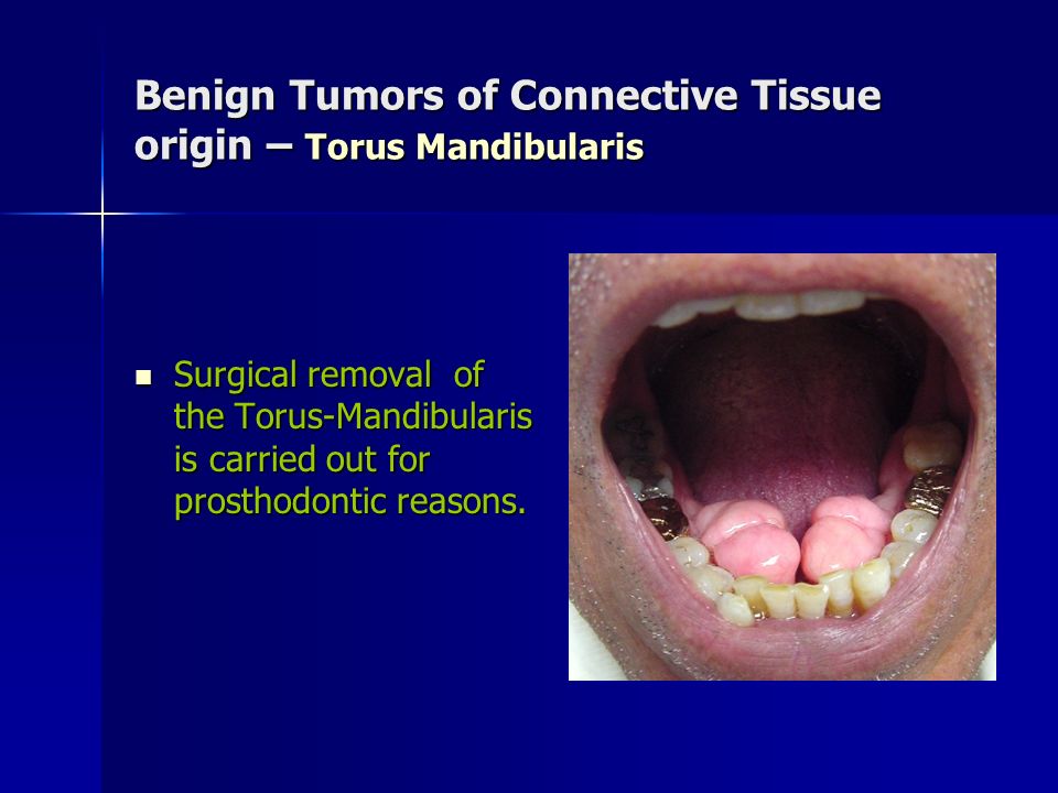 Benign Tumors of Connective Tissue origin – Torus Mandibularis