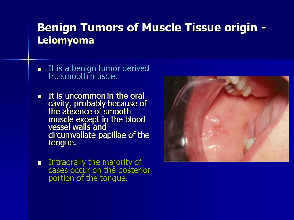 Presentation on theme: "Benign Tumors of the Oral Cavity"- Presen...
