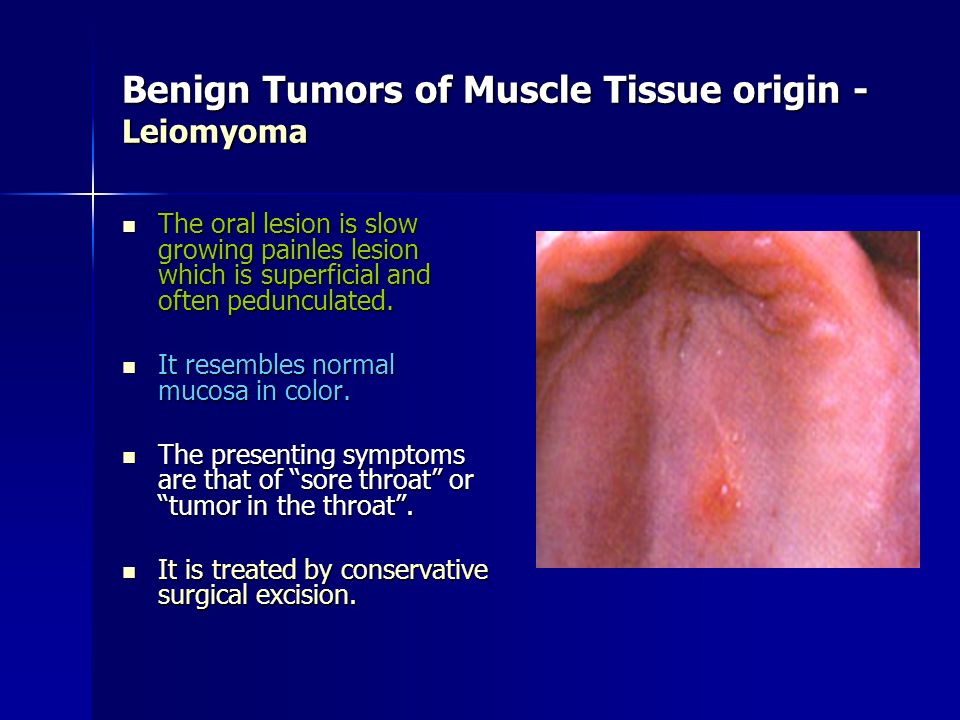 Benign Tumors of Muscle Tissue origin - Leiomyoma
