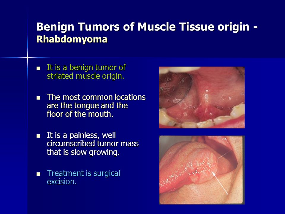 Benign Tumors of Muscle Tissue origin - Rhabdomyoma