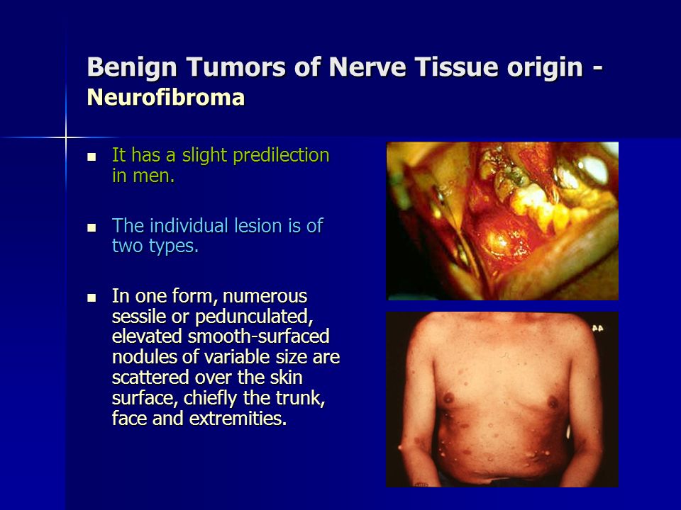 Benign Tumors of Nerve Tissue origin - Neurofibroma