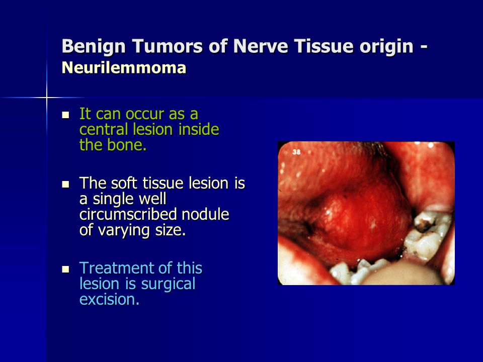 Benign Tumors of Nerve Tissue origin - Neurilemmoma