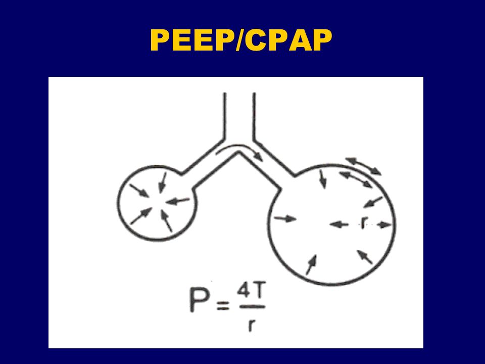 PEEP/CPAP