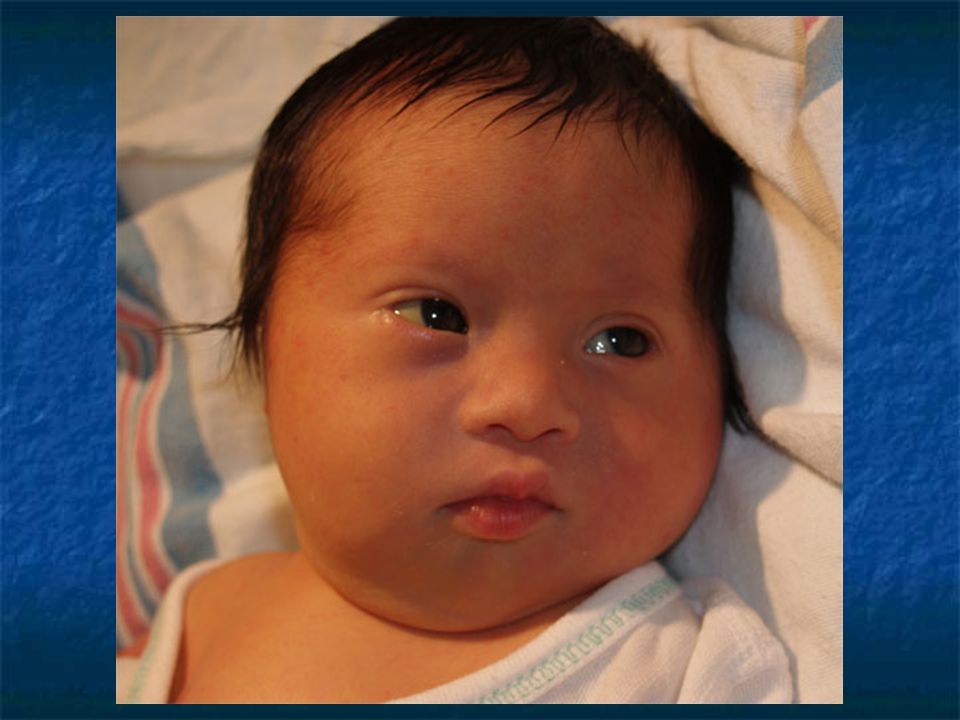 Родился с черными волосами. Эпикантус синдром Дауна. Эпикант, монголоидный разрез глаз. Дети с узкими глазами. Разрез глаз у новорожденных.