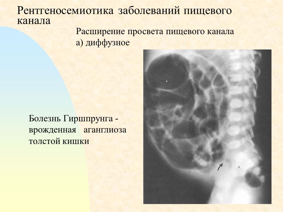 Гиршпрунга клинические рекомендации