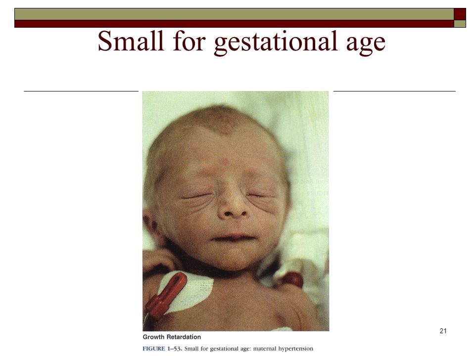 small for gestational age infants