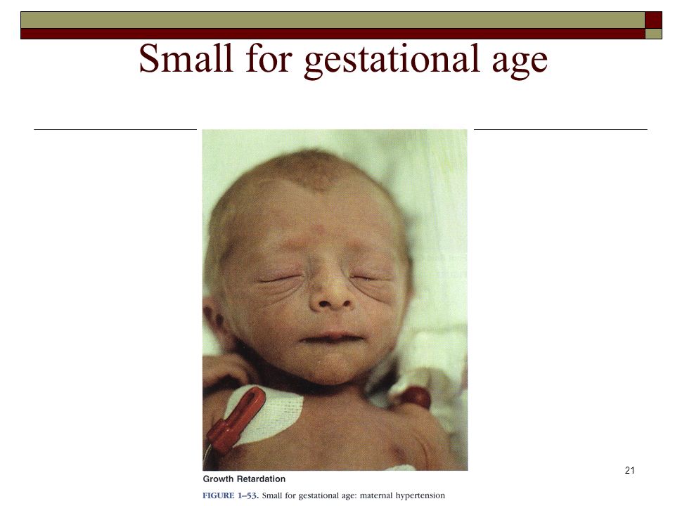 baby small for gestational age