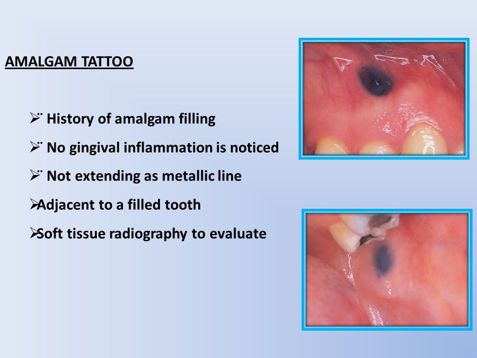 Tattoo in the Oral Cavity  The American Journal of Medicine