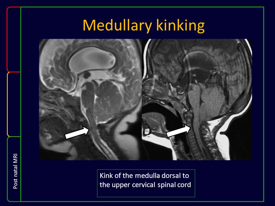 Medullary kinking Kink of the medulla dorsal to the upper cervical spinal cord