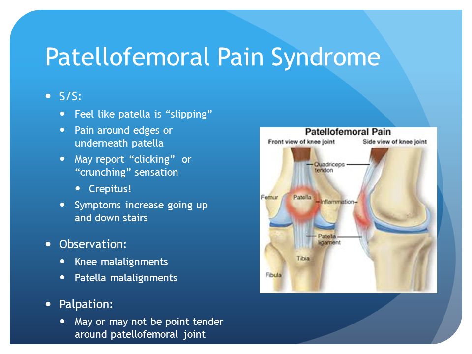 Pain syndrome. Пателло бедренный синдром.