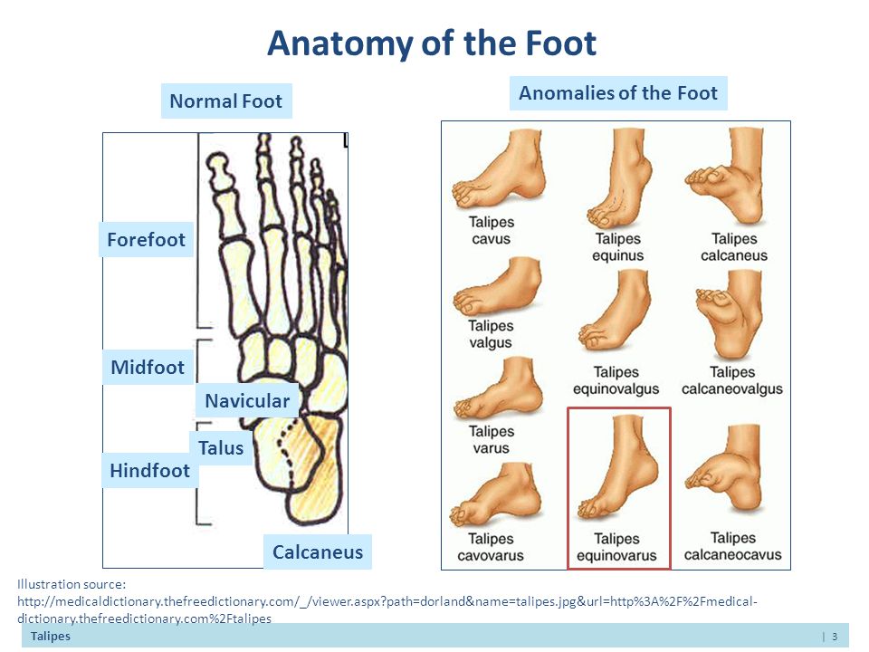 Idiopathic Talipes Equinovarus Congenital Clubfoot Ppt Video Online Download