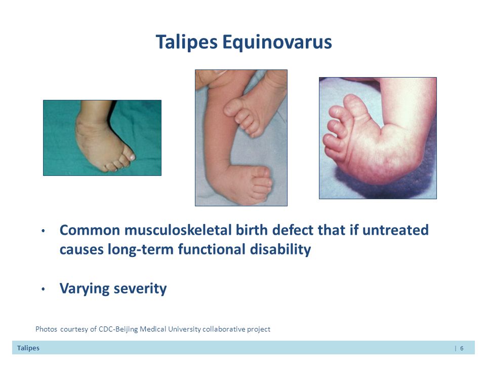 Idiopathic Talipes Equinovarus Congenital Clubfoot Ppt Video Online Download