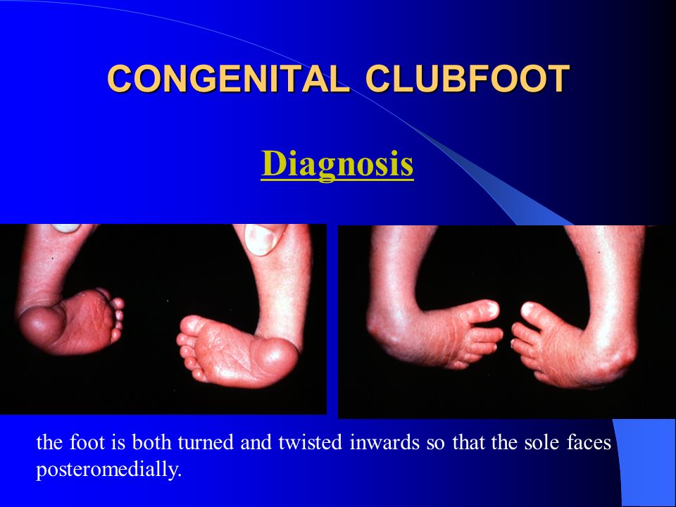 Congenital Clubfoot Congenital Talipes Equino Varus Ppt Video Online Download Congenital Clubfoot Congenital Talipes Equino Varus Ppt Video Online Download