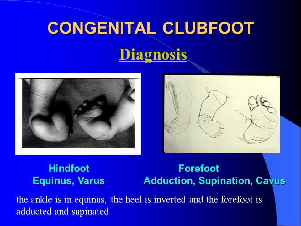 Congenital Clubfoot Congenital Talipes Equino Varus Ppt Video Online Download Congenital Clubfoot Congenital Talipes Equino Varus Ppt Video Online Download