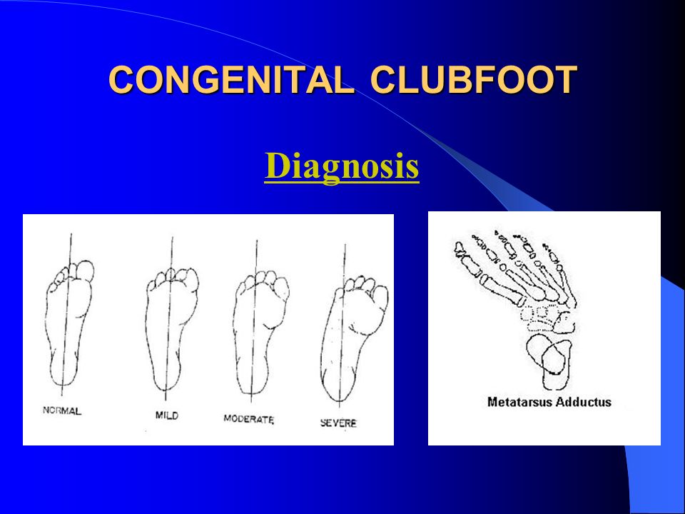 Congenital Clubfoot Congenital Talipes Equino Varus Ppt Video Online Download Congenital Clubfoot Congenital Talipes Equino Varus Ppt Video Online Download