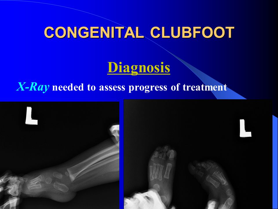 Congenital Clubfoot Congenital Talipes Equino Varus Ppt Video Online Download Congenital Clubfoot Congenital Talipes Equino Varus Ppt Video Online Download