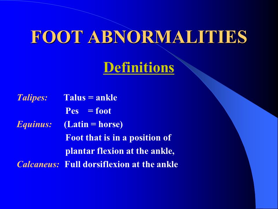 Congenital Clubfoot Congenital Talipes Equino Varus Ppt Video Online Download Congenital Clubfoot Congenital Talipes Equino Varus Ppt Video Online Download