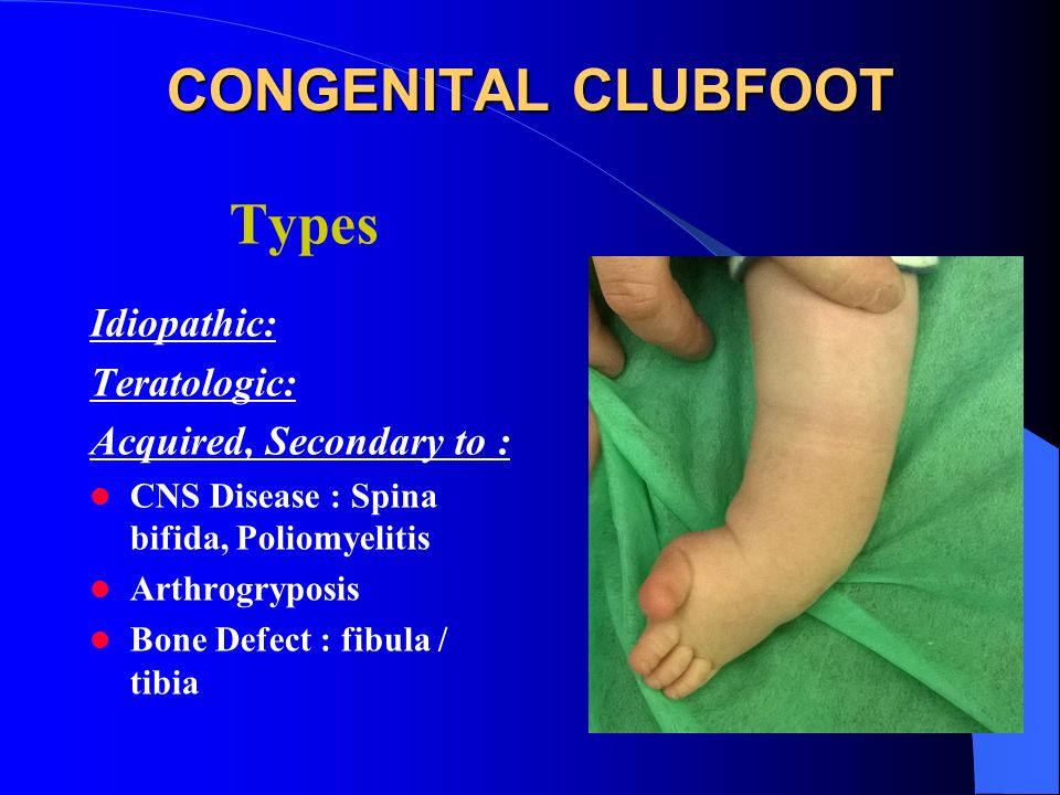Congenital Clubfoot Congenital Talipes Equino Varus Ppt Video Online Download