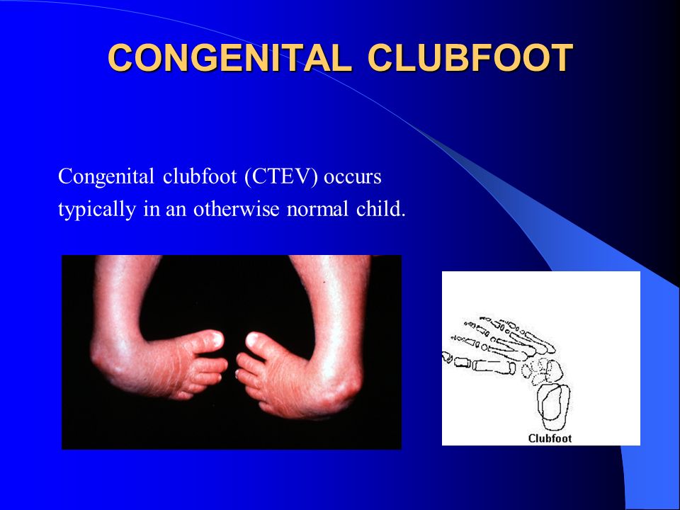Congenital Clubfoot Congenital Talipes Equino Varus Ppt Video Online Download Congenital Clubfoot Congenital Talipes Equino Varus Ppt Video Online Download
