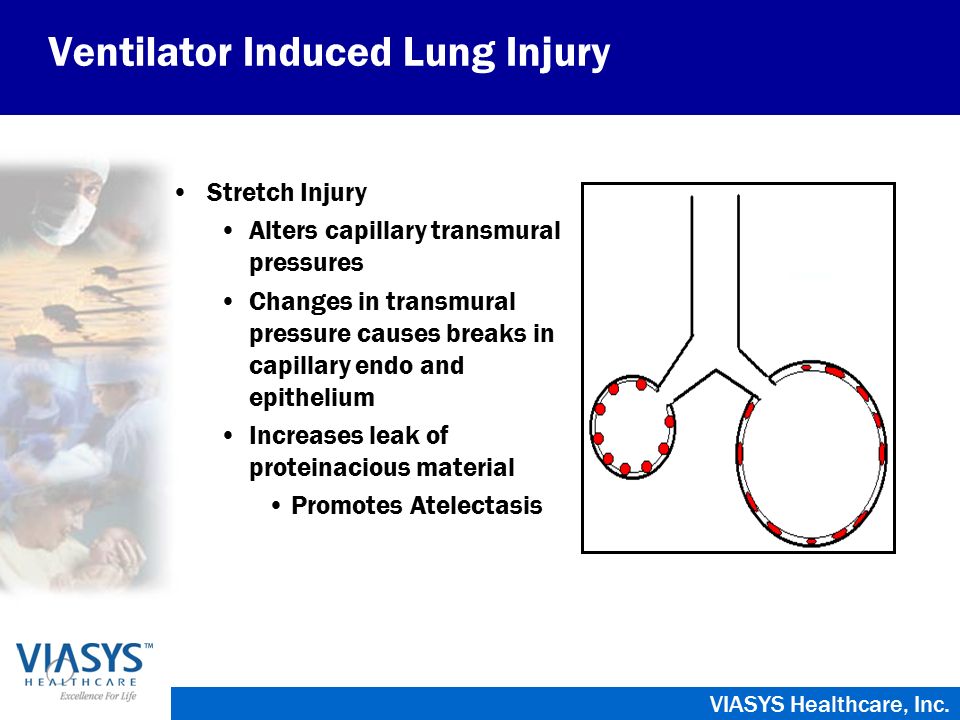 Ventilator Induced Lung Injury - ppt video online download