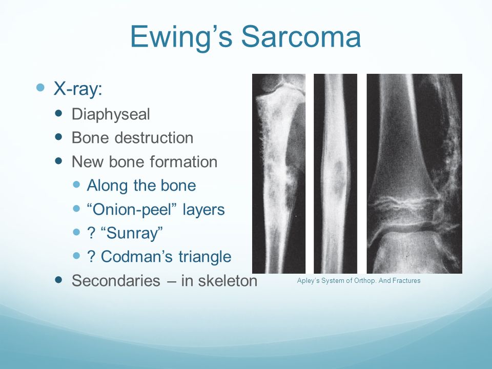 Саркома юинга у детей. Саркома Юинга мягких тканей. Опухоль Юинга рентгенологическая картина.