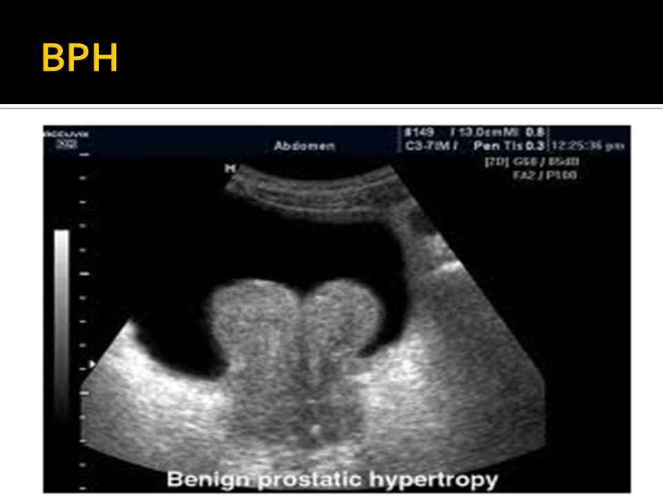 benign prostatic hyperplasia ultrasound classification