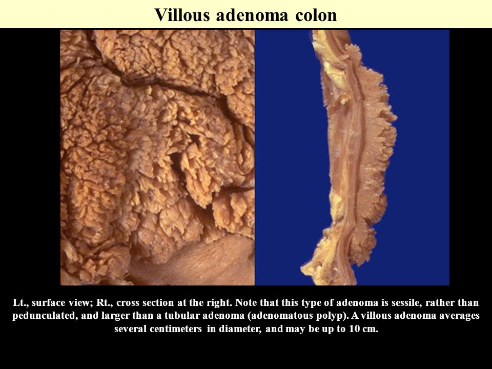villous adenoma gross