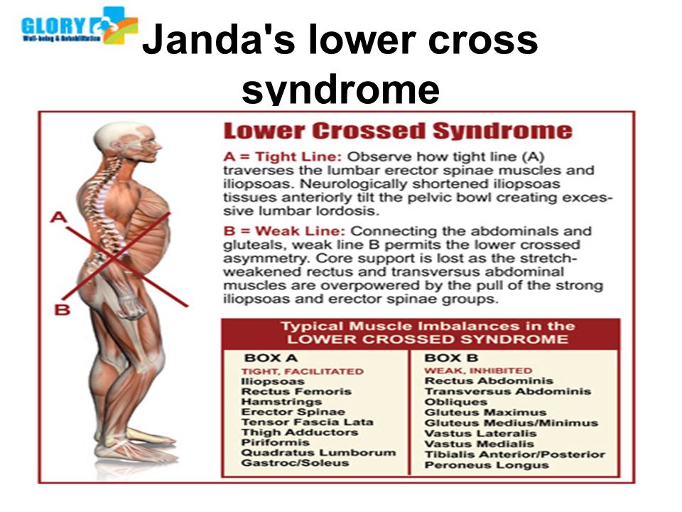 Lower crossing. Muscle imbalance. Lower Trunk. Low Cross Syndrome Type b.