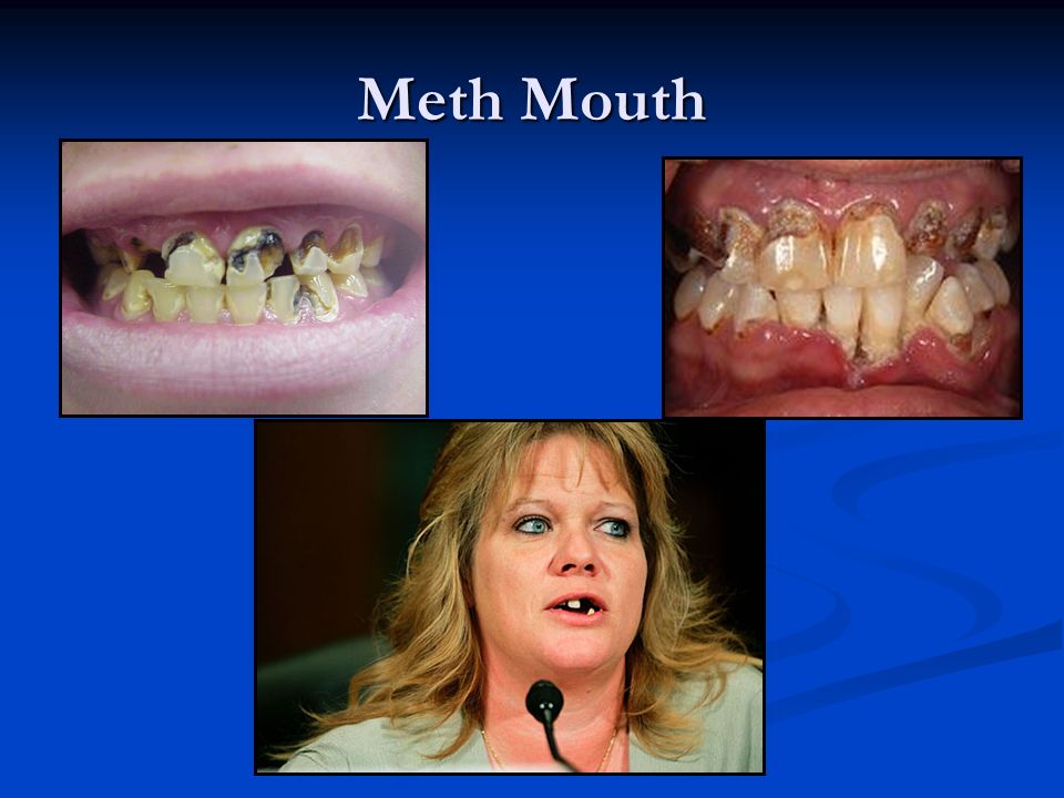 Meth Mouth. 