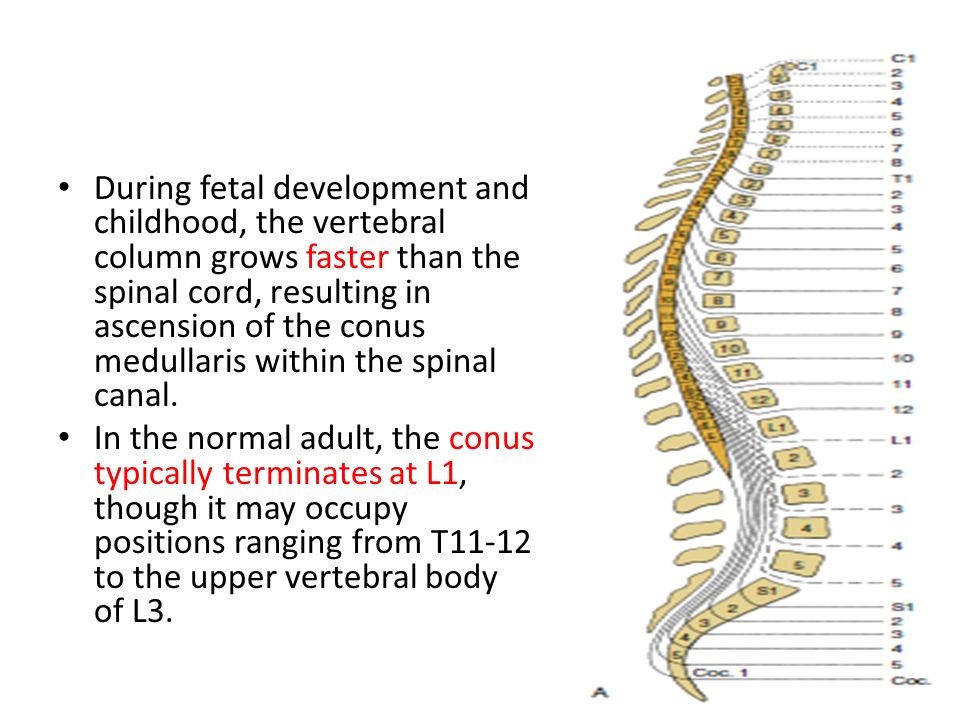 Фиксированный спинной. Фиксированный спинной мозг. Development of Spinal Cord. Фиксированный спинной мозг у детей. Синдром фиксированного спинного мозга у детей.