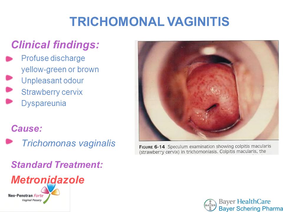 Trichomonas colpitis - tünetek