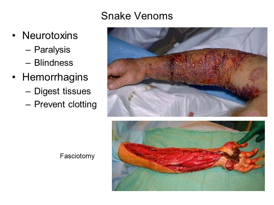 Snake Venoms Neurotoxins Hemorrhagins Paralysis Blindness