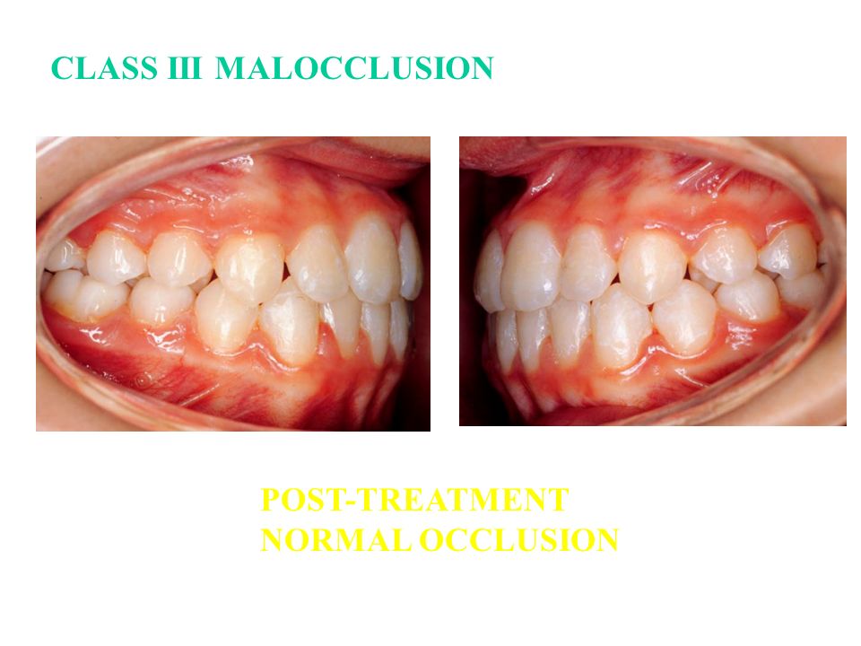 normal occlusion