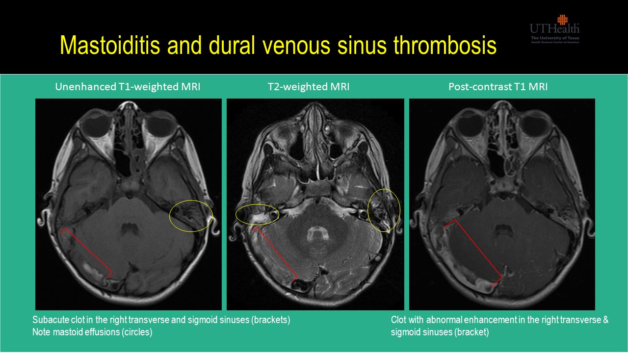 Гипоплазия сигмовидных синусов. Тромбоз кавернозного синуса мрт. Тромбоз сигмовидного синуса на кт.