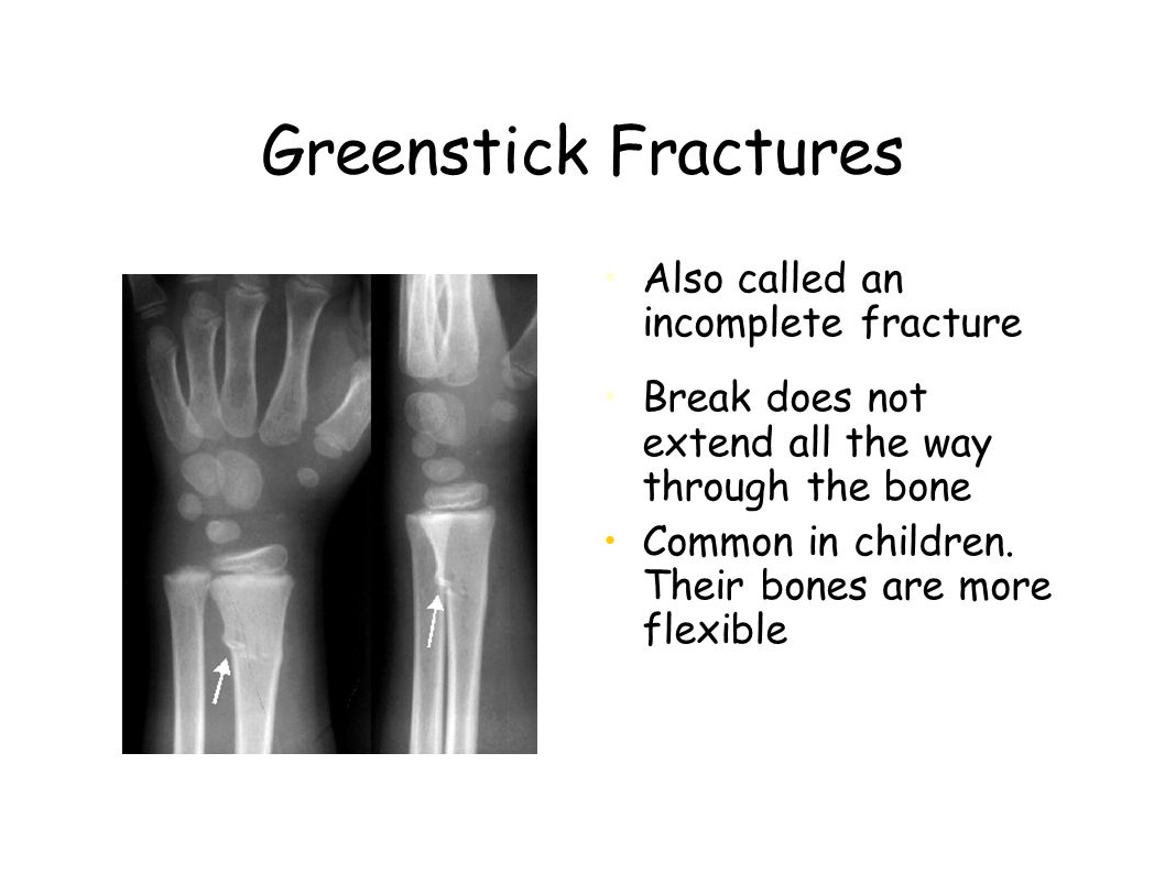 Greenstick Fractures Also called an incomplete fracture