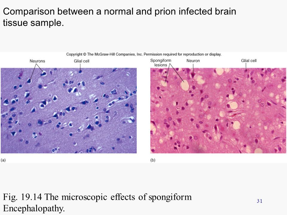 Comparison between a normal and prion infected brain tissue sample.