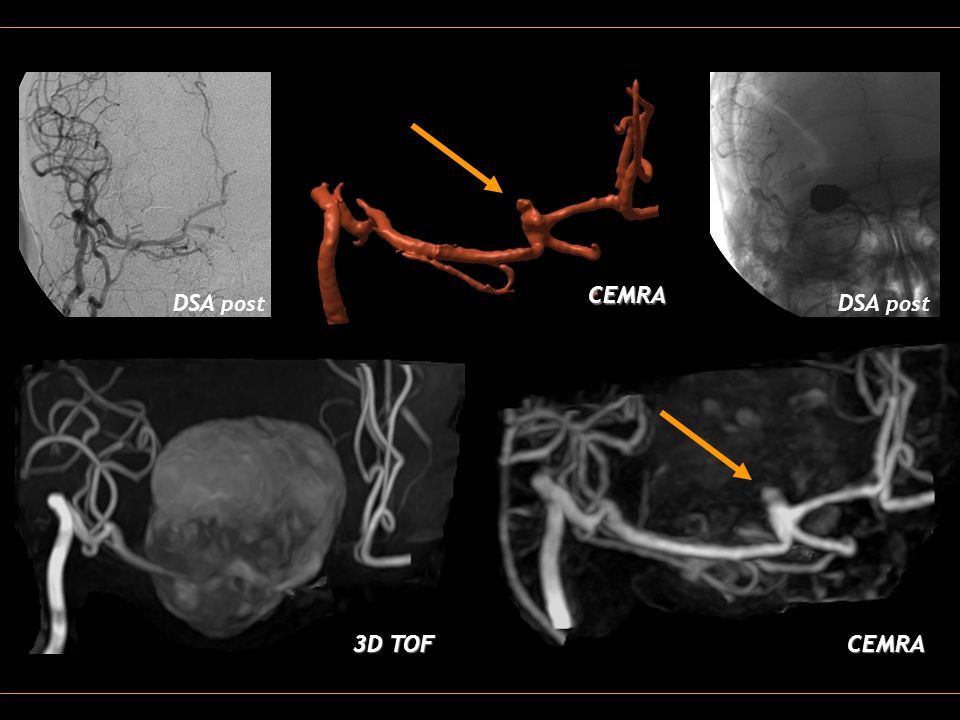 MR Angiography at 3T in the follow-up of coiled cerebral aneurysms: - ppt  video online download