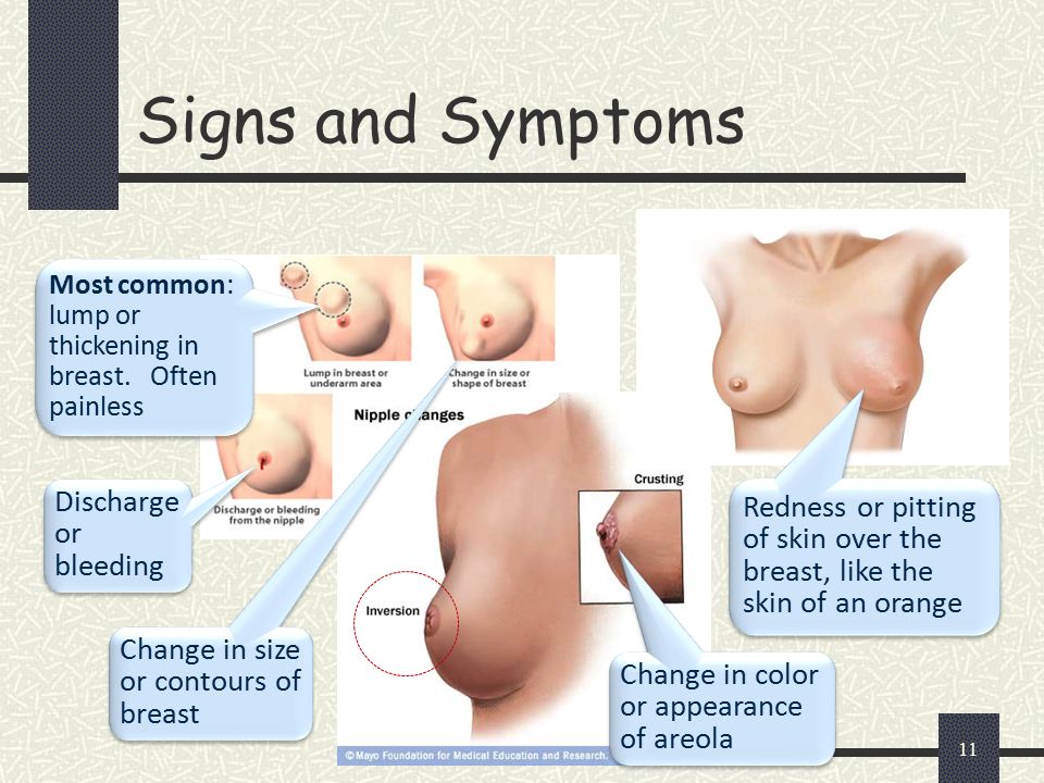 Breast cancer free porn - 🧡 What Are Symptoms Of Breast Cancer - What Is ....