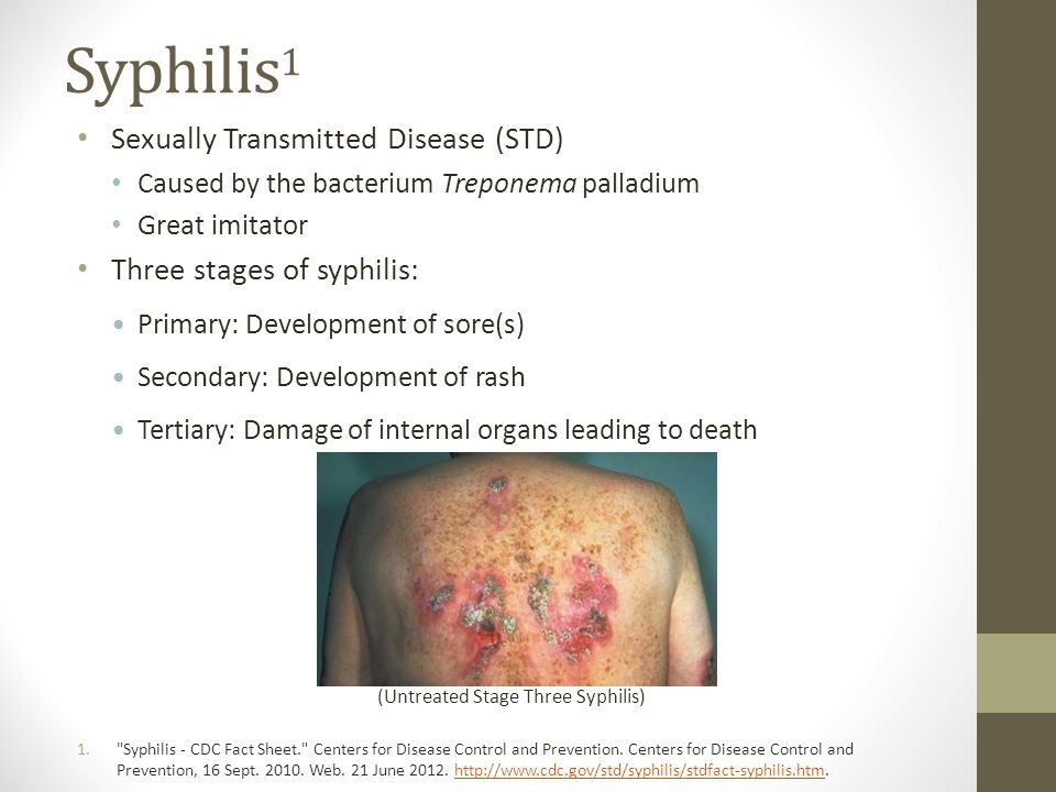 Chlamydia, Syphilis, And Gonorrhea