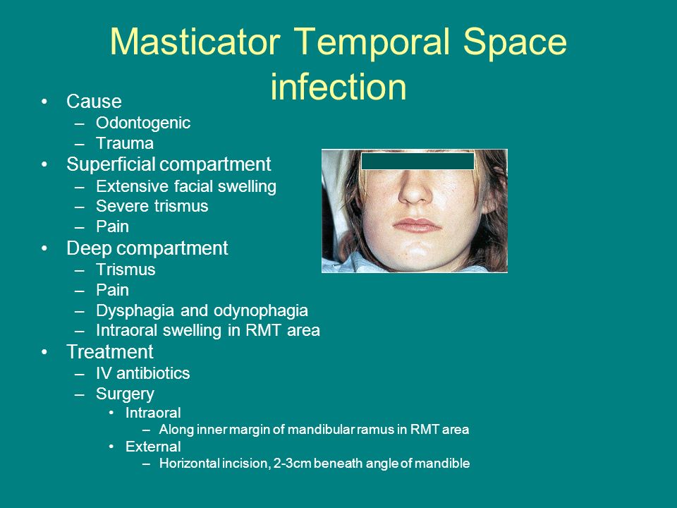 Deep Neck Spaces Surgical Anatomy And Infections Ppt Video