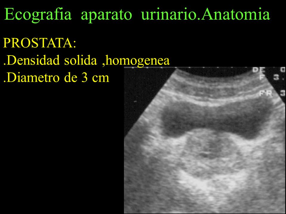 ecografía de próstata transabdominal prostatite cronica batterica